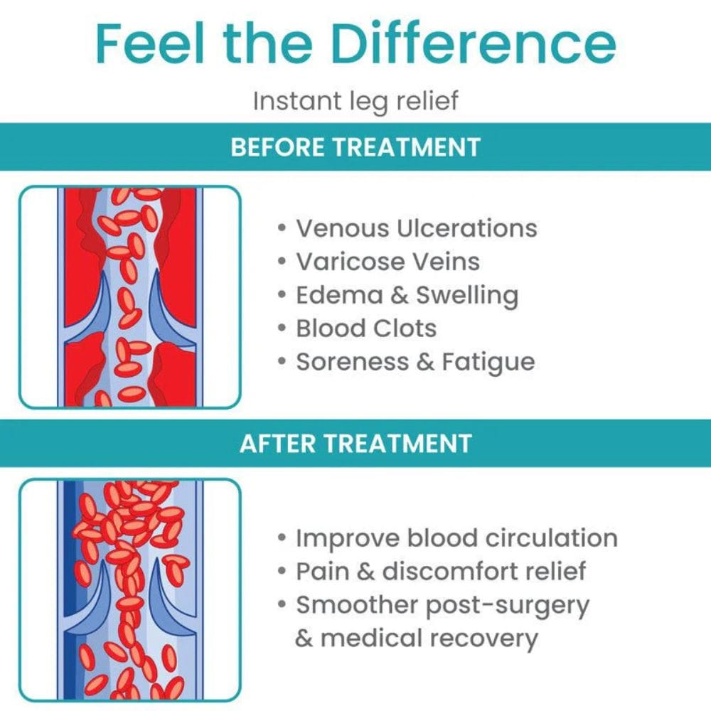 Diagram showing before and after treatment effects on leg veins with text 'Feel the Difference'.